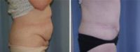 54 years old / status post gastric bypass abdominoplasty