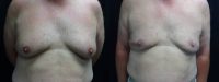 55-64 year old man treated with Male Breast Reduction