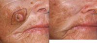55-64 year old woman treated with Cheek Lesion Removal