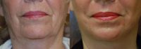 55-64 year old woman treated with Laser Resurfacing with J-Plasma
