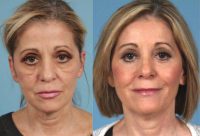 55-64 year old woman treated with Eyelid Surgery (Upper and Lower Blepharoplasty) and Mid-Facelift