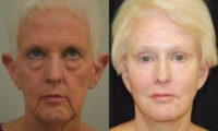 55-64 year old woman treated with FULL Face Lift