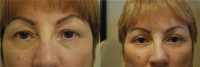 60 year old woman treated with Eyelid Surgery