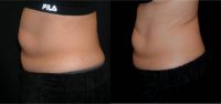55-64 year old woman treated with SculpSure
