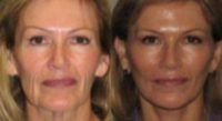 62 year old woman treated with Facelift