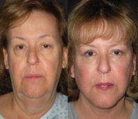 62 year old woman treated with Facelift