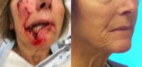 62 year-old female treated with Facial Reconstruction After Dog Bite