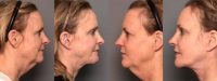 62 yr old female with face and neck aging changes
