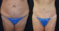 55-64 year old man treated with Tummy Tuck