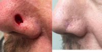 55-64 year old man treated with Mohs Surgery