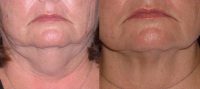 55-64 year old woman treated with Liposuction of the neck