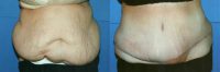 64 year old woman with large abdominal panniculus
