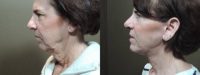 65-74 year old woman treated with Lower Face Lift
