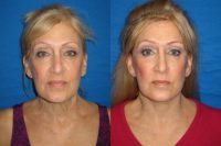 66 year old woman who underwent facelift and eyelid surgery