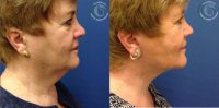 65-74 year old woman treated with Neck Lift