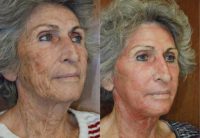 65-74 year old woman treated with Laser Resurfacing with J-Plasma