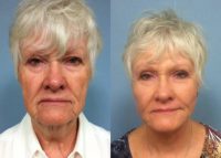 65-74 year old female treated with Facelift