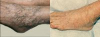 65-74 year old woman treated with Sclerotherapy