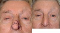 65-74 year old man treated with Nose Reconstruction Surgery