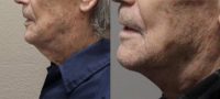 75 and up year old man treated with Neck Lift