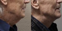 75 and up year old man treated with Neck Lift