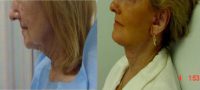 75 and up year old woman treated with Neck Lift