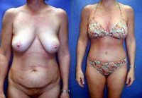 Breast Lift With Implants, Tummy Tuck (Abdominoplasty), Arm Lift Before With Doctor Tom J. Pousti, MD, FACS, San Diego Plastic Surgeon