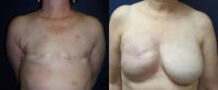 Breast Reconstruction-Fat Grafting