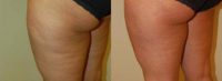 Cellulaze Before and After Pictures