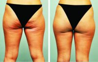 Cellulaze™ buttocks & back of thighs 38 yr. old - 2 months after treatment