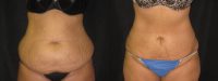 liposuction of abdomen
