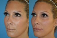 45-54 year old woman treated with Juvederm Voluma
