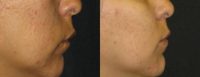 25-34 year old man treated with Lip Augmentation