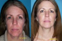 Laser resurfacing with filler and skin care
