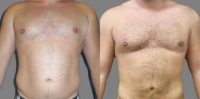 Male, mid 30s, liposuction of waist and abdomen