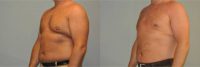 52 year old man treated with Male Breast Reduction