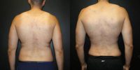 31 year old male treated with Liposuction