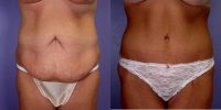 Doctor David Stoker, MD, Los Angeles Plastic Surgeon - After Weight Loss Tummy Tuck