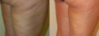 Cellulaze Before and After Pictures