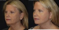 56 year old female wishing facial rejuvenation.