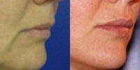 57 year old woman treated with Injectable Fillers