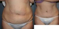 Laser Liposuction and Tummy Tuck