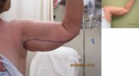 60 Year Old Treated for Extra Skin of Arms/Brachioplasty