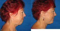68 year old woman treated with Facelift, eyelid surgery, and liposuction of the neck