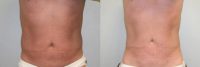 43 Year Old Male treated for fat removal and to enhance tissue tightening - Smartlipo