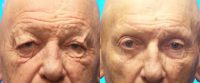70 year-old male treated with Eyelid Surgery