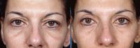35-44 year old woman treated with Upper Blepharoplasty