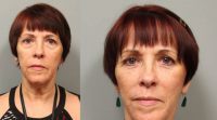 58 Year Old Female Who Desired Rejuvenated Appearance, Facelift Surgery