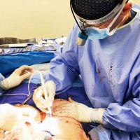 Doctor Joseph Poggi, MD, Wichita Board Certified Plastic Surgeon Mini Abdominoplasty Procedure Picture