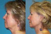 Neck lift with fat grafting around the mouth